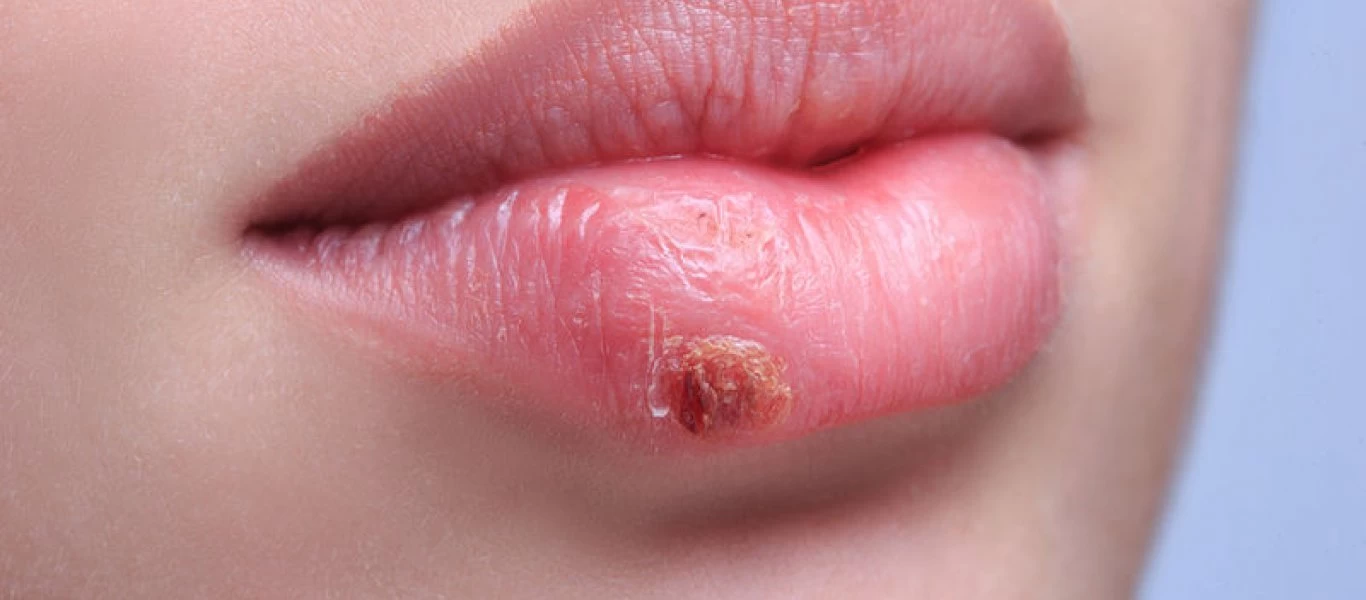 Τα πάντα γύρω από τον επιχείλιο έρπη